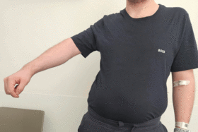 Henning H. demonstriert, wie eingeschränkt die Bewegung seines rechten Arms vor der OP war und wie gut er den Arm inzwischen wieder bewegen kann.