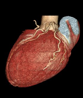 Darstellung eines Herzens mit der Computertomographie-Koronarangiographie 